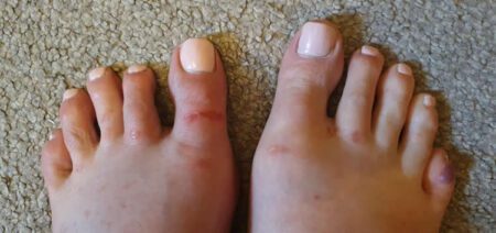 bruisedfeet
