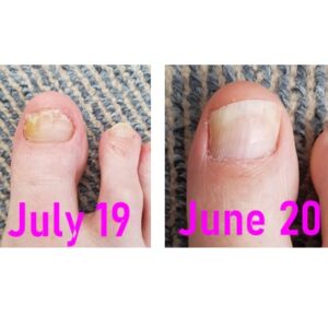 How I Got Rid Of Fungal Nail